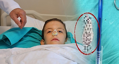 Burun tıkanıklığı, kulak ağrısıyla gitti: Ağzından dev polip çıkartıldı